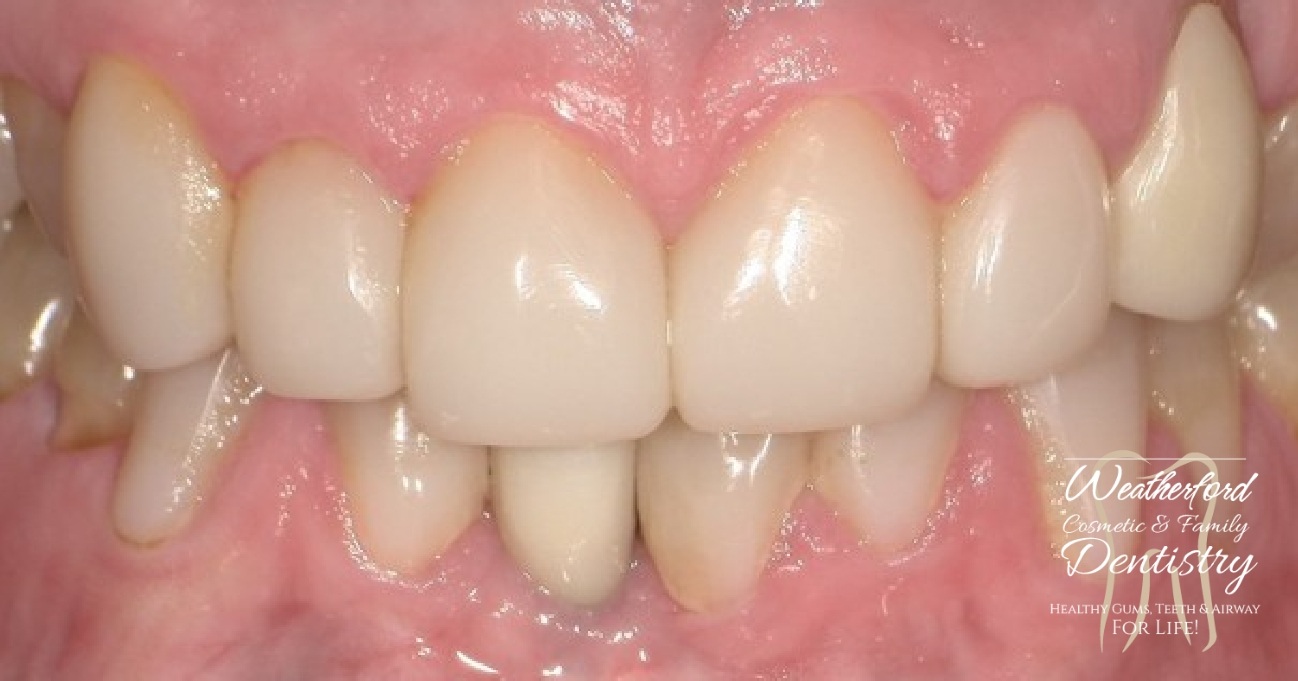 Close up of flawless smile after Bioclear dental bonding