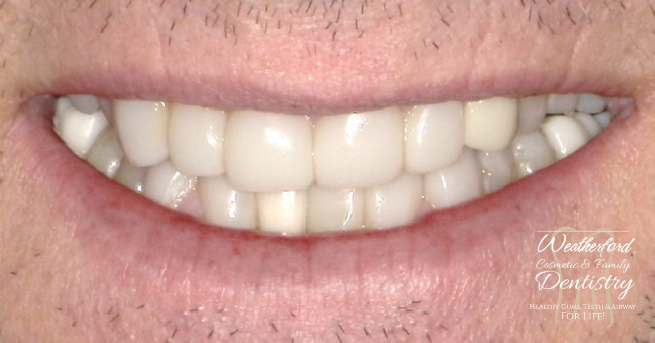 Close up of flawless smile after Bioclear dental bonding