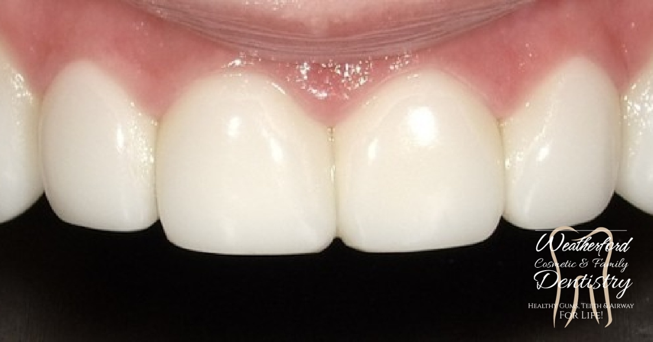Close up of flawless smile after Bioclear dental bonding