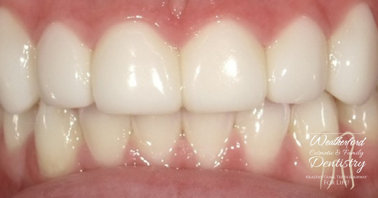 Close up of flawless smile after Bioclear dental bonding