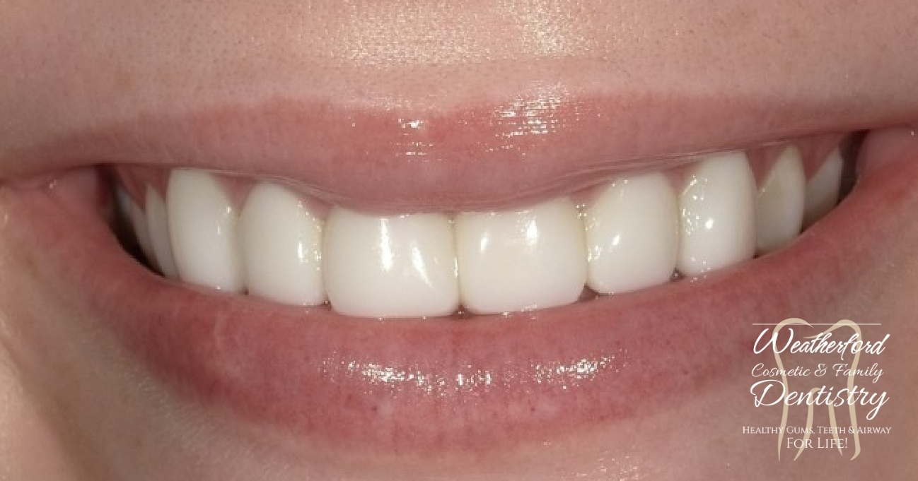 Close up of flawless smile after Bioclear dental bonding