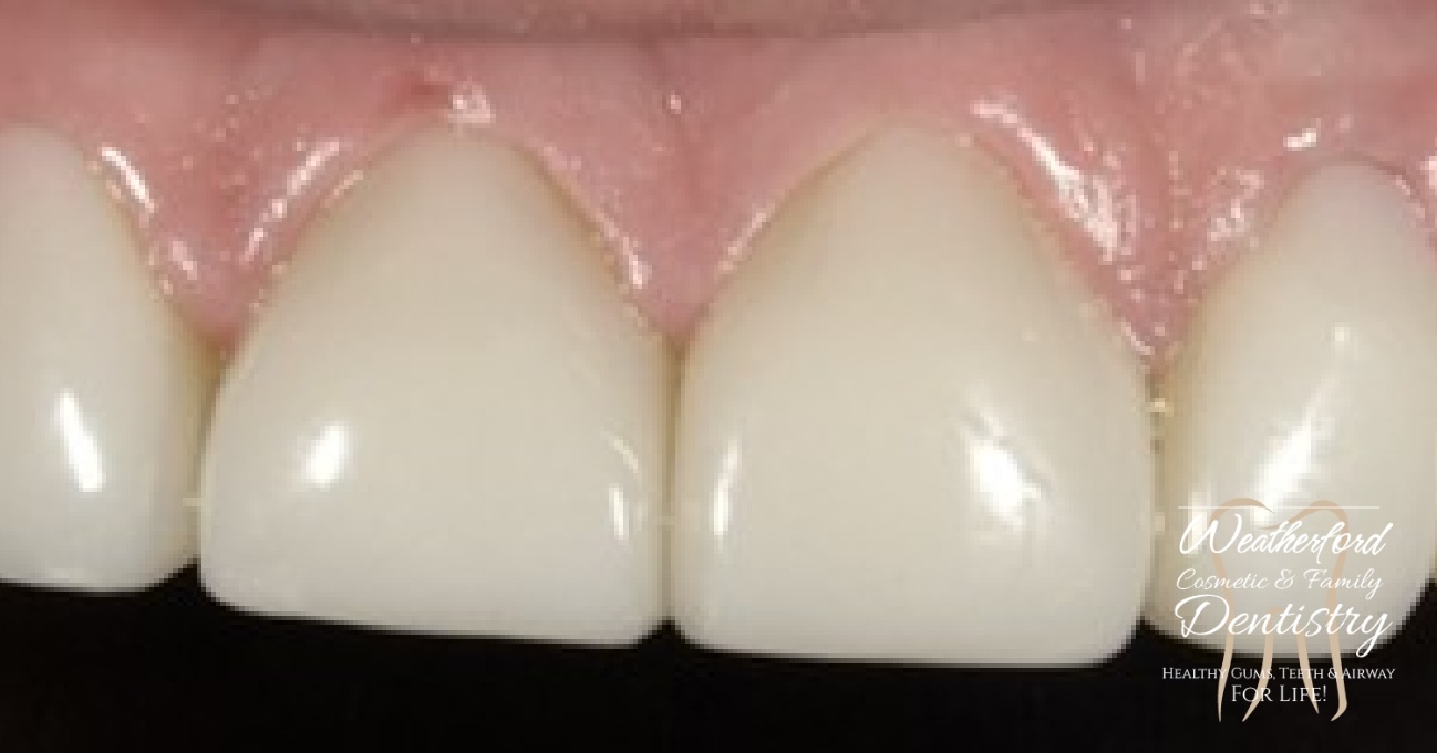 Close up of flawless smile after Bioclear dental bonding