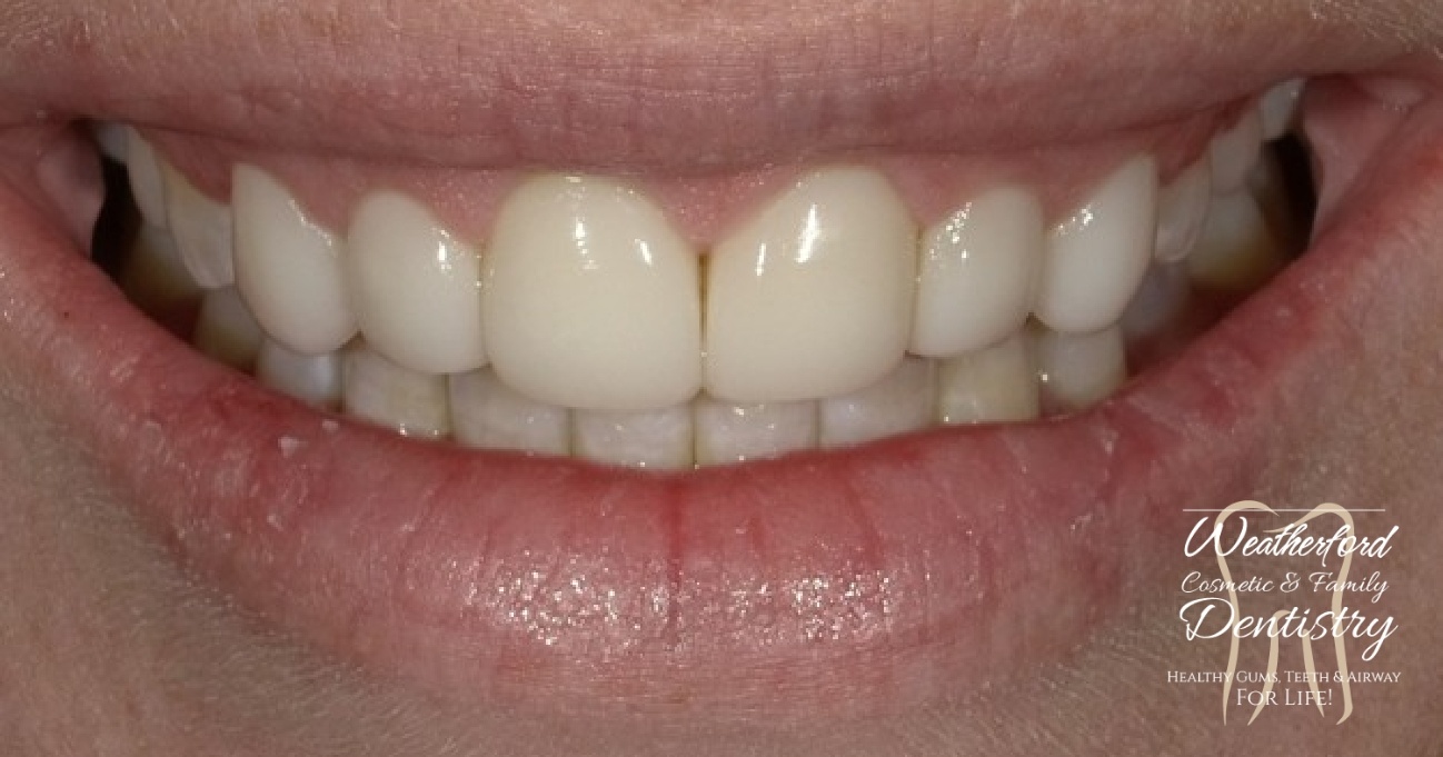 Close up of flawless smile after Bioclear dental bonding