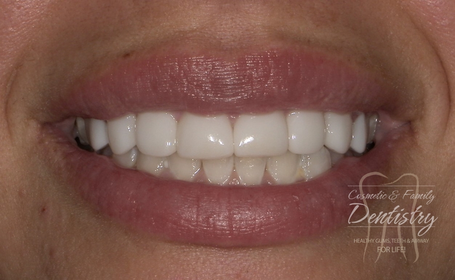 Close up of flawless smile after Bioclear dental bonding