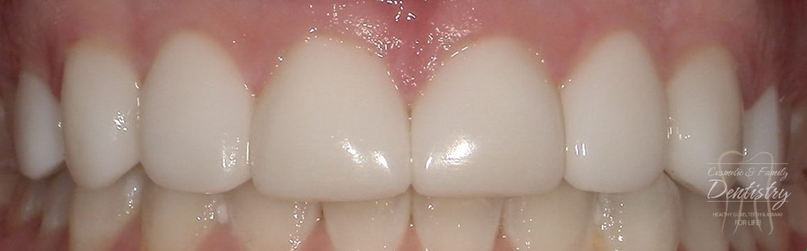Close up of flawless smile after Bioclear dental bonding