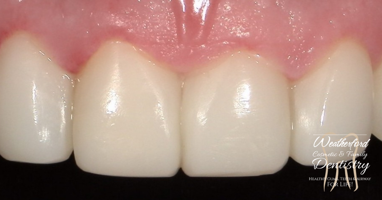 Close up of flawless smile after Bioclear dental bonding