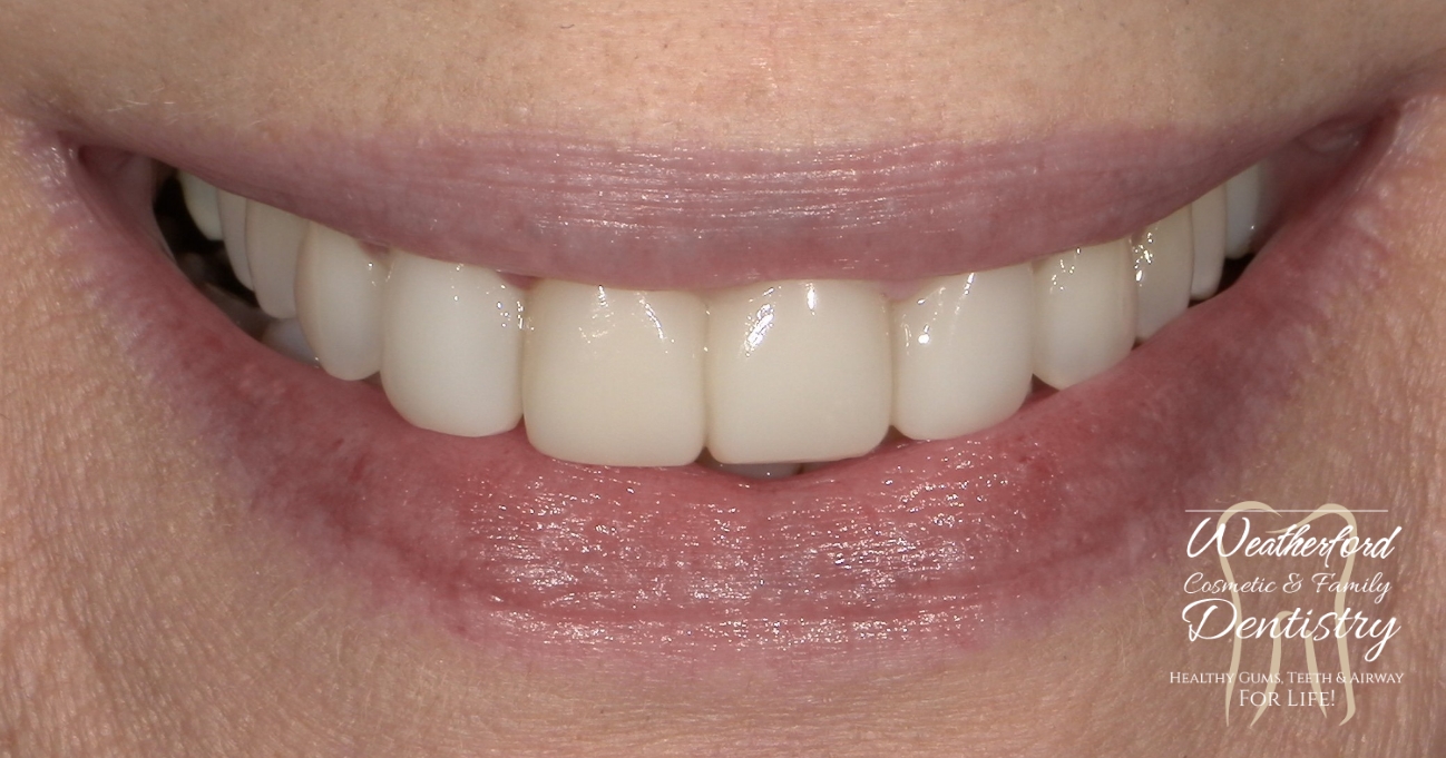 Close up of flawless smile after Bioclear dental bonding