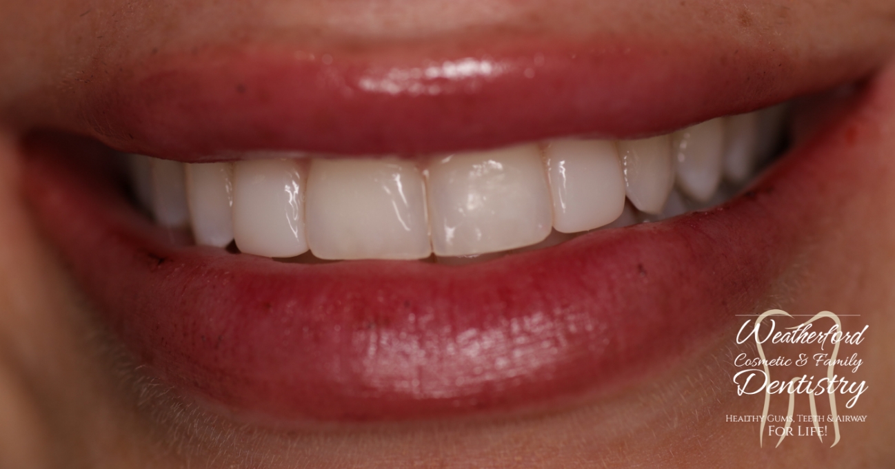 Close up of flawless smile after Bioclear dental bonding