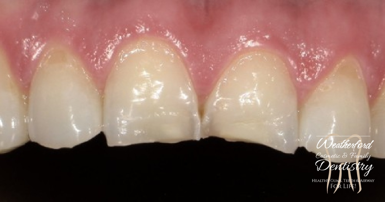 Close up of imperfect teeth before Bioclear dental bonding