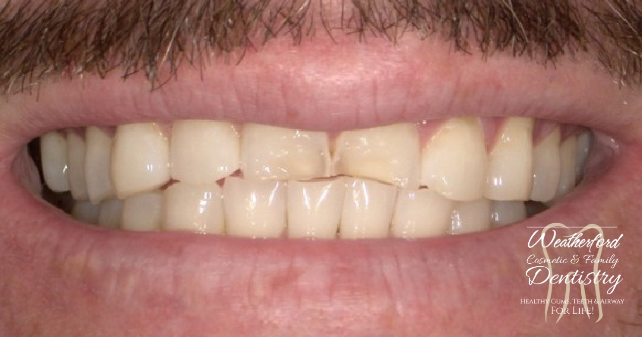 Close up of imperfect teeth before Bioclear dental bonding