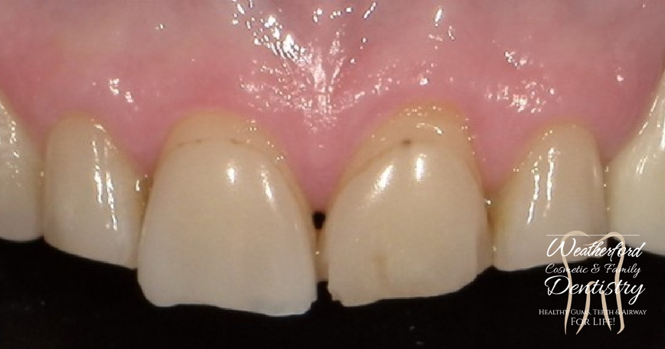 Close up of imperfect teeth before Bioclear dental bonding