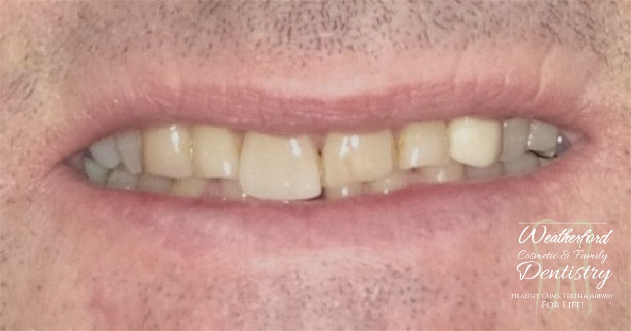 Close up of imperfect teeth before Bioclear dental bonding