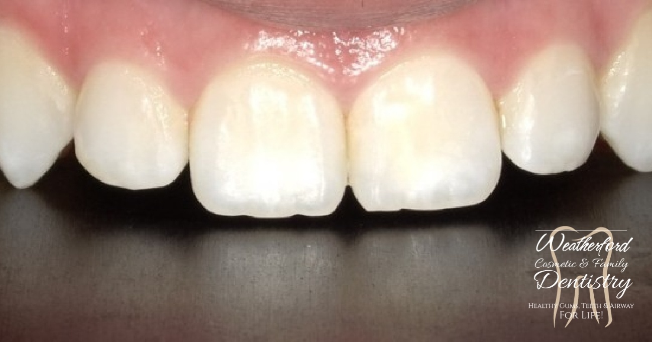 Close up of imperfect teeth before Bioclear dental bonding