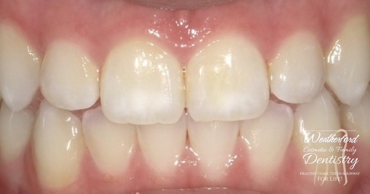 Close up of imperfect teeth before Bioclear dental bonding