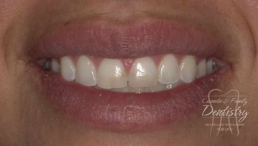 Close up of imperfect teeth before Bioclear dental bonding