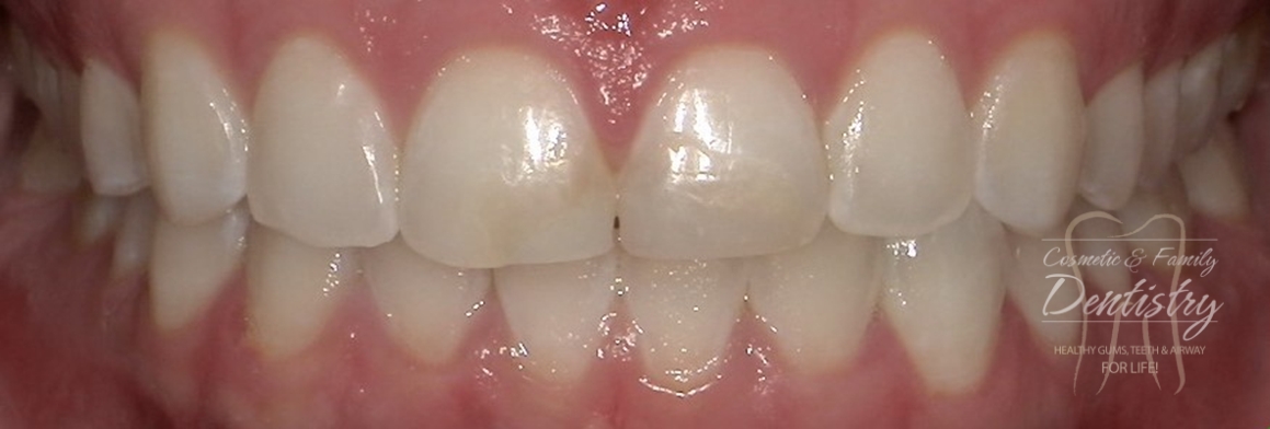 Close up of imperfect teeth before Bioclear dental bonding