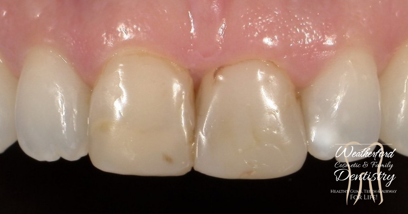 Close up of imperfect teeth before Bioclear dental bonding