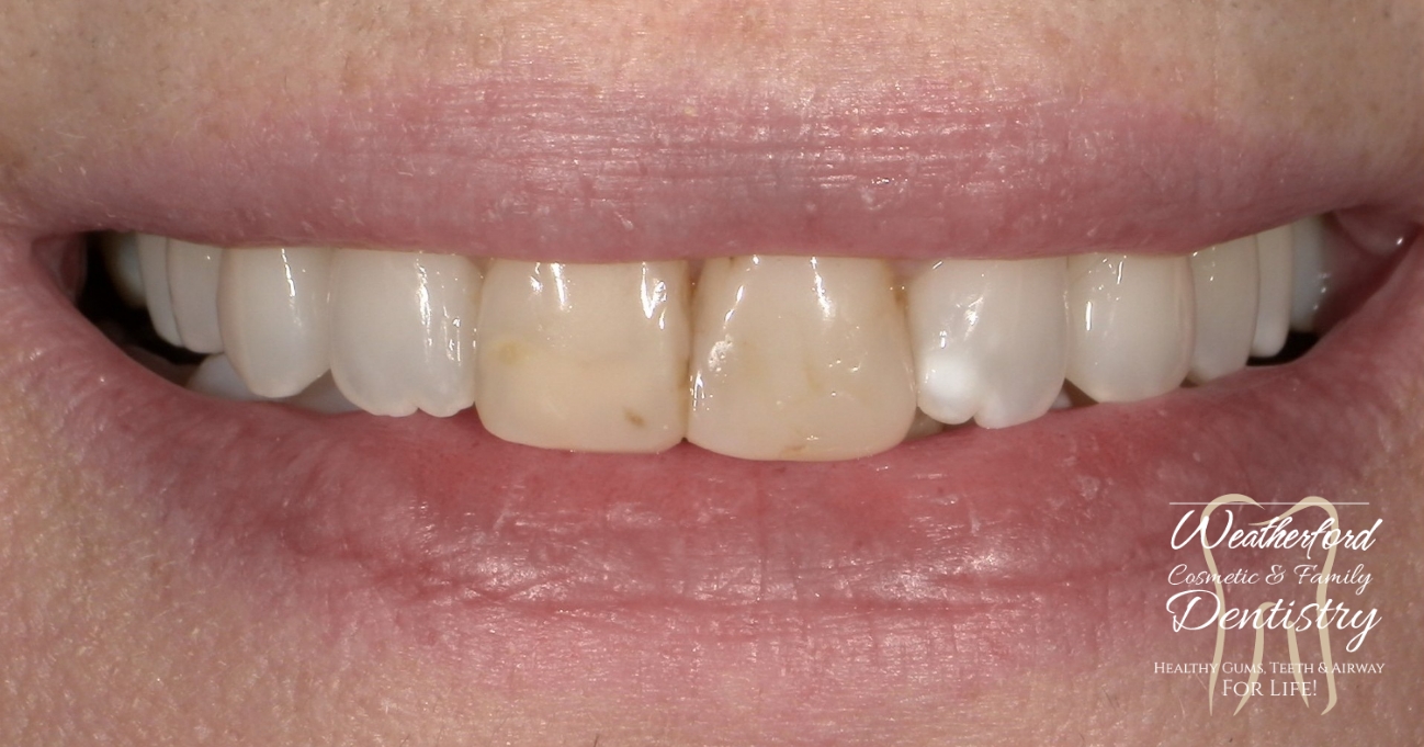 Close up of imperfect teeth before Bioclear dental bonding