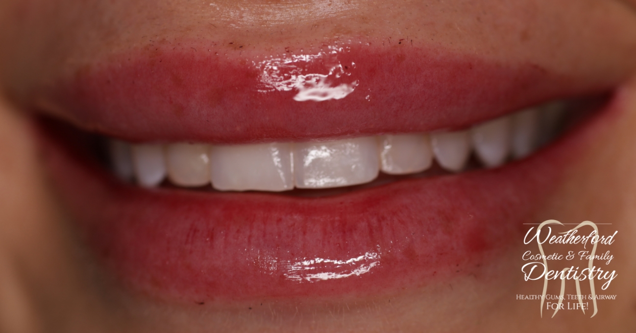 Close up of imperfect teeth before Bioclear dental bonding
