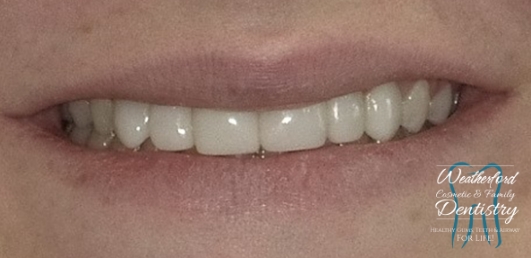 Close up of flawless smile after Bioclear dental bonding