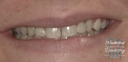 Close up of imperfect teeth before Bioclear dental bonding