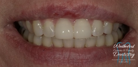 Close up of flawless smile after Bioclear dental bonding