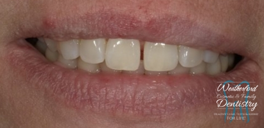 Close up of imperfect teeth before Bioclear dental bonding