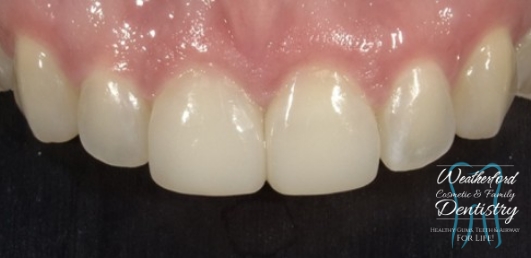 Close up of flawless smile after Bioclear dental bonding