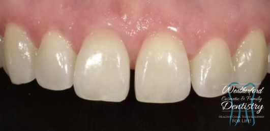 Close up of imperfect teeth before Bioclear dental bonding