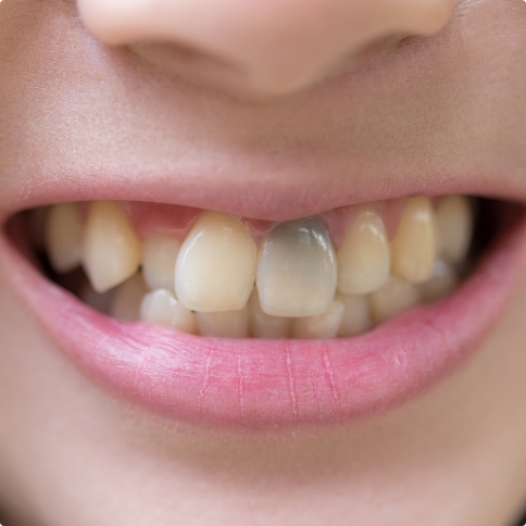 Close up of mouth with discolored teeth before teeth whitening in Weatherford