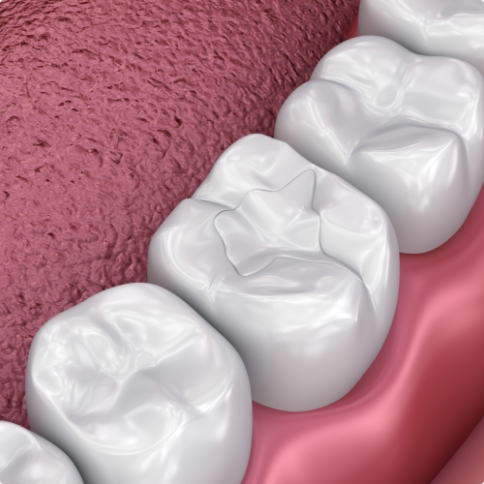 Illustrated tooth with barely noticeable filling