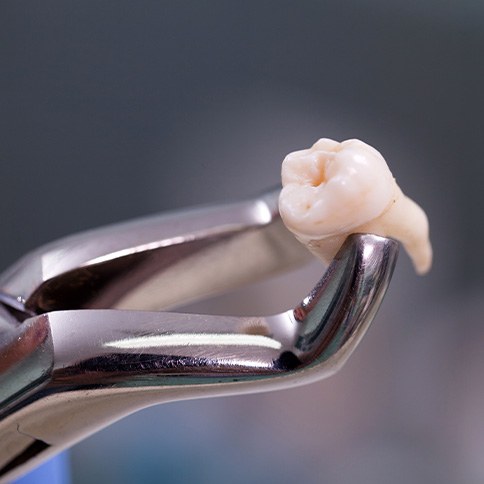 Closeup of extracted tooth held by forceps