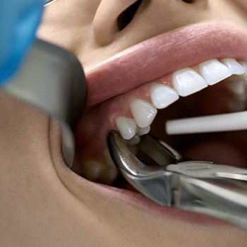 Closeup of forceps grasping a woman’s tooth