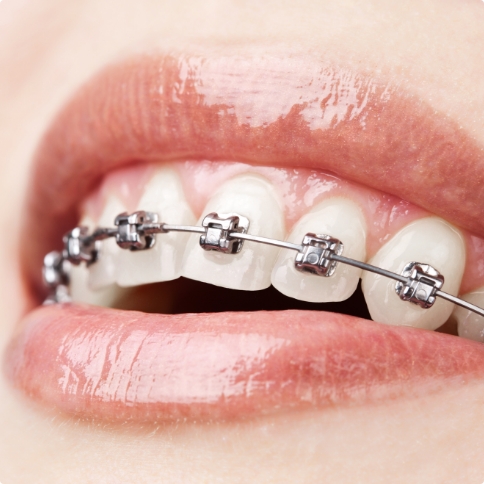 Close up of smile with braces on upper teeth