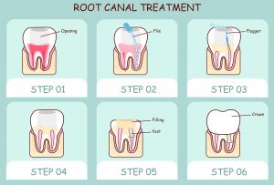 Root canal therapy from Weatherford dentists, Dr. Romack and Dr. Mulkey, preserves failing teeth. Learn answers to questions about this procedure. 