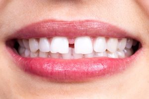 Closeup of a person's mouth who has a gap between their two front teeth