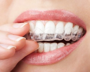 Shutterstock Invisalign