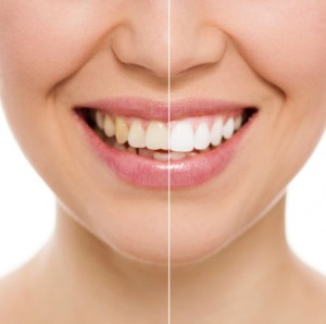 The newest teeth whitening treatment to get your smile looking beautiful.