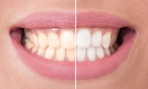 Healthy teeth can get stained say Weatherford dentists, Drs. Deborah Romack and Garrett Mulkey. Dietary changes keep whitened teeth looking bright.