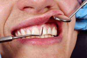 A patient having their gums inspected for signs of gum disease.