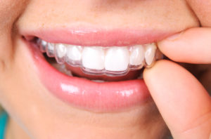 young woman Invisalign clear aligners