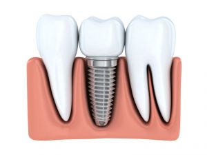 Our highly skilled dentists are your one stop for dental implants in Weatherford.